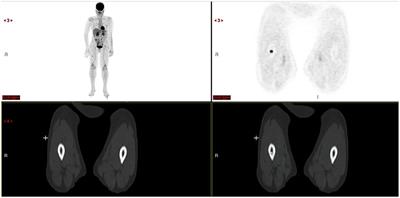 Interest of Pet Imaging in Multiple Myeloma